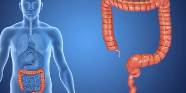 Kolon Kanseri Nedir?