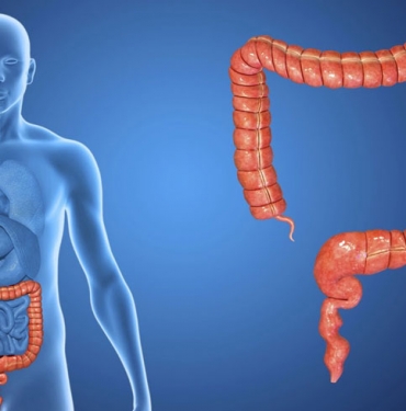 Kolon Kanseri Nedir?