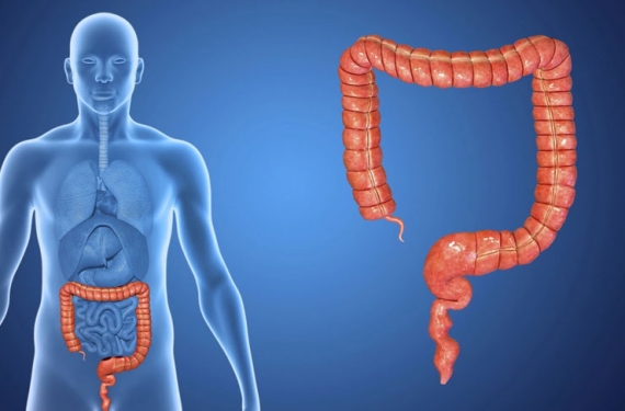 Kolon Kanseri Nedir?