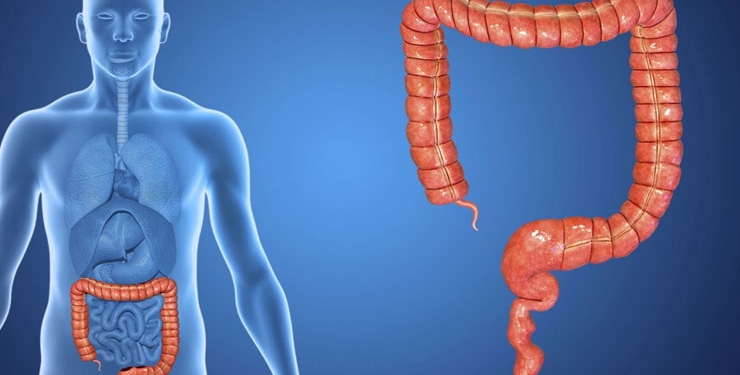 Kolon Kanseri Nedir? Kolon Kanseri Tedavisi Nasıl Yapılır?