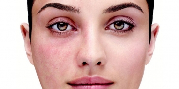 Gül Hastalığı Nasıl Geçer?