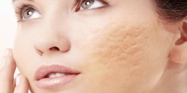 Sivilce Lekeleri Nasıl Geçer?