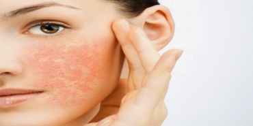Yüz Kızarması Hangi Hastalıkların Belirtisidir?