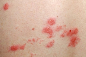 Gece Yanığı Nedir?