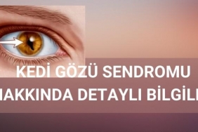 Kedi Gözü Sendromu Nedir?