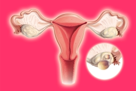 Polikistik over sendromu nedenleri