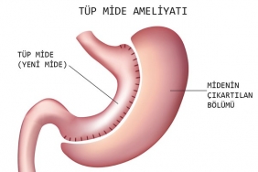 Tüp Mide Ameliyatı