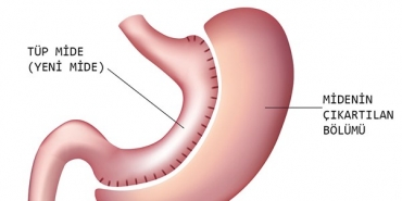 Tüp Mide Ameliyatı