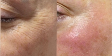 Kolajen İp Uygulamaları