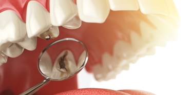Diş Çürüğü Nedir?