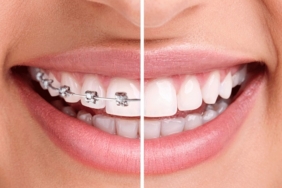 Diş teli fiyatları