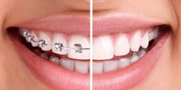 Diş teli fiyatları