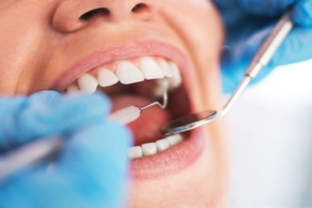 Diş Çürüğü Tedavi