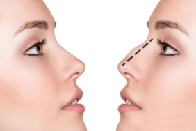 Burun Eti Ameliyatı Sonrası