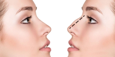 Burun Eti Ameliyatı Sonrası