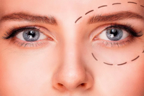 Göz Kapağı Düşüklüğü Tedavisi