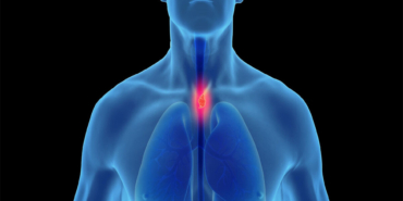 Yemek Borusu Kanseri Belirtileri