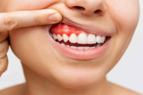 Diş eti estetiği nedir?