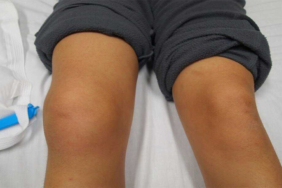 Patella Çıkığı Ameliyatı