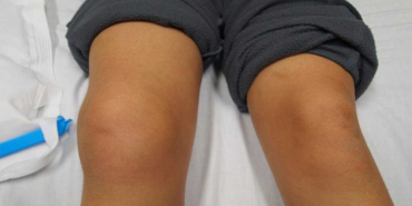 Patella Çıkığı Ameliyatı