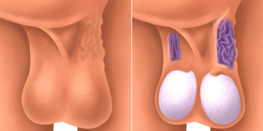 Varikosel Tedavisi Nedir?