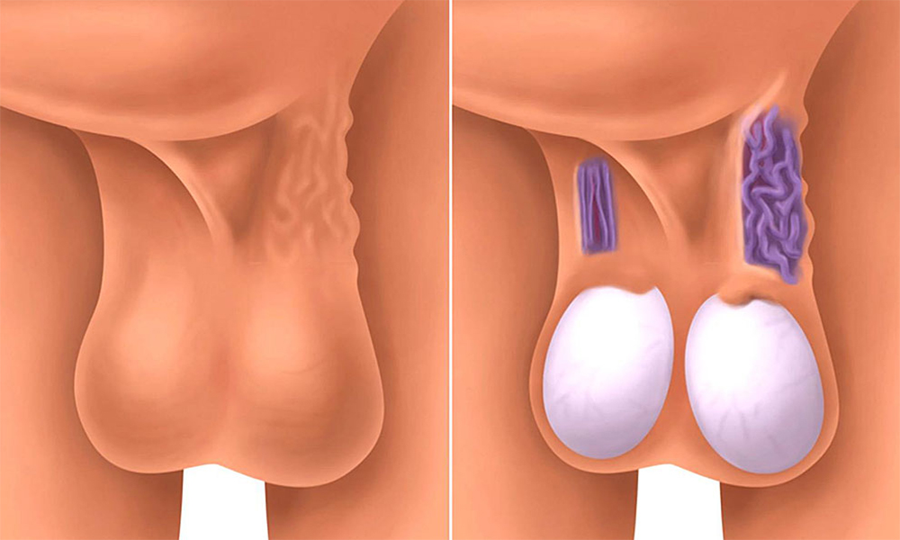 Varikosel Tedavisi Nedir?