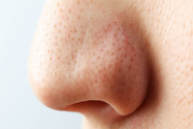 Burun Ucu Düşmesi Nedir?