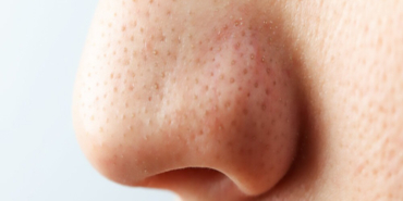 Burun Ucu Düşmesi Nedir?