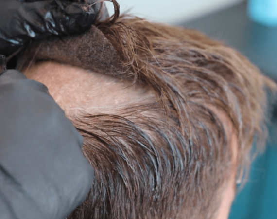 Protez Saç Yeni Görünüm Yeni Başlangıç