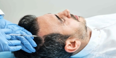 Kök hücreli saç ekimi