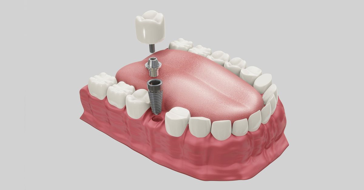 İmplant kimler için uygundur?