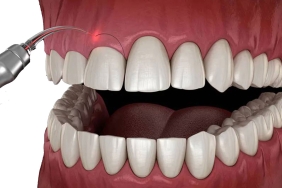 Diş Eti Estetiği Hangi Durumlarda Uygulanır?