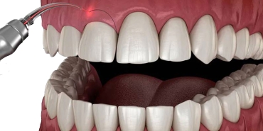 Diş Eti Estetiği Hangi Durumlarda Uygulanır?