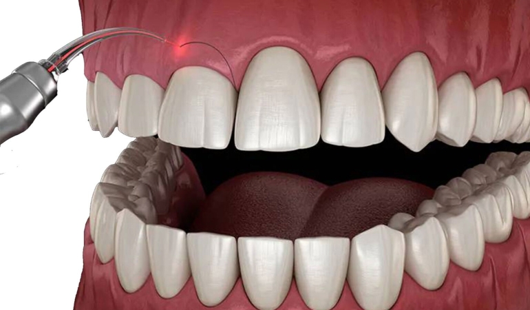 Diş Eti Estetiği Hangi Durumlarda Uygulanır?