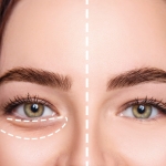 Göz altı çukuru ameliyatı