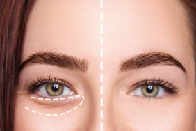 Göz altı çukuru ameliyatı