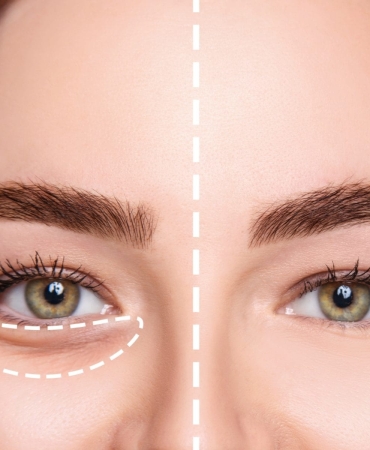 Göz altı çukuru ameliyatı