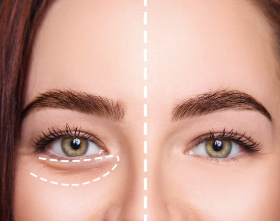 Göz altı çukuru ameliyatı