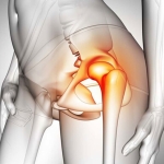 Kalça Kireçlenmesi Ameliyat