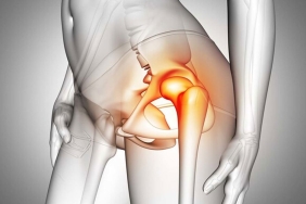 Kalça Kireçlenmesi Ameliyat