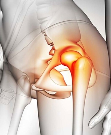 Kalça Kireçlenmesi Ameliyat