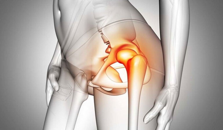 Kalça Kireçlenmesi Ameliyat