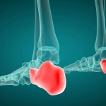 Sever Hastalığı Nedir?