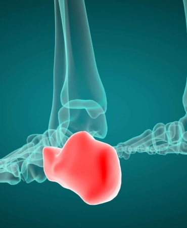 Sever Hastalığı Nedir?