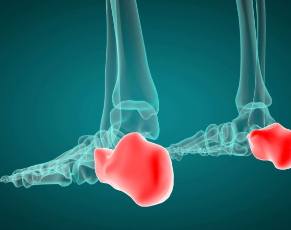 Sever Hastalığı Nedir?