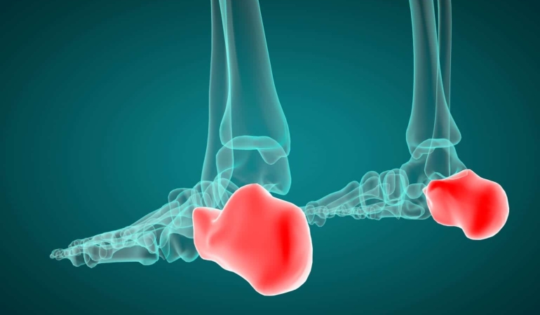 Sever Hastalığı Nedir?