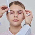 Blefaroplasti Nedir?