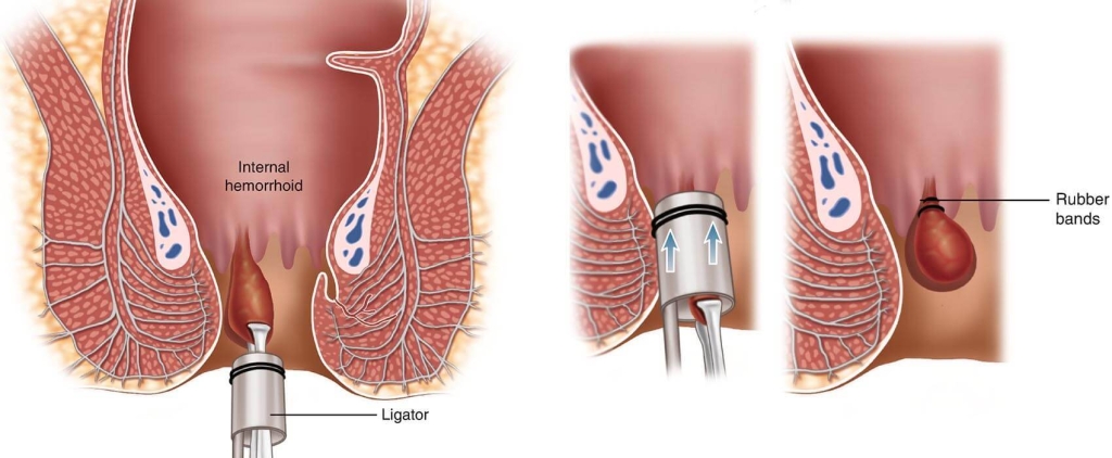 İç Hemoroid