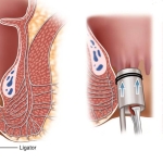 İç Hemoroid