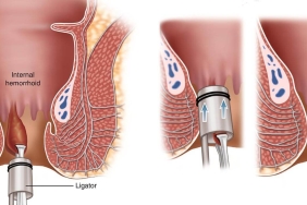 İç Hemoroid